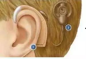 网友爆料耳蜗钉视频大全,网友爆料揭秘耳蜗植入全过程 第3张 网友爆料耳蜗钉视频大全,网友爆料揭秘耳蜗植入全过程 第3张